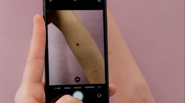 VIDEO / Liječnici otkrili pet znakova koja upozoravaju da bi madež mogao biti kancerogen